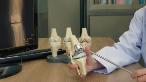 Exactech Class Action Lawsuit: Files and Legal Assistance Info